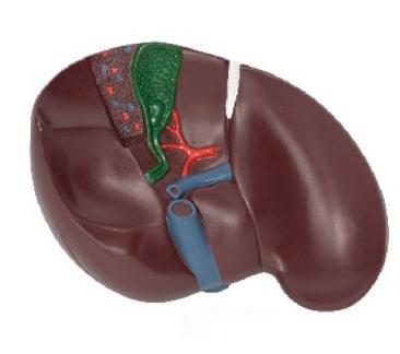 肝胆结石模型
