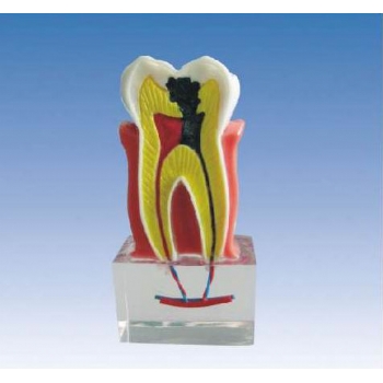 龋齿解剖模型
