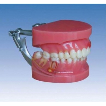 牙周病演示模型